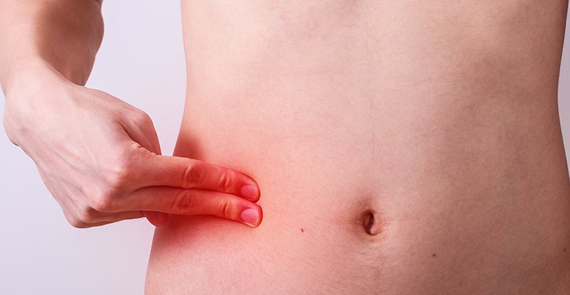 Appendicitis