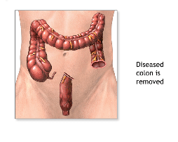 diverticulitis-colon