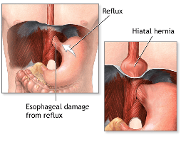 reflux-disease-1