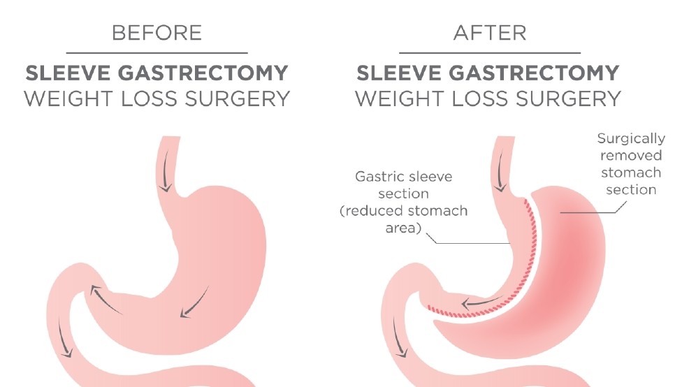 Gastric Sleeve Surgery