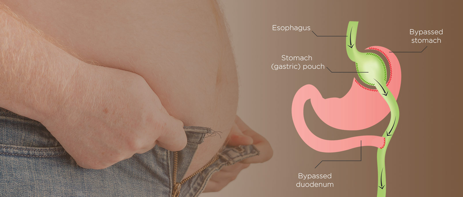 Gastric-Bypass