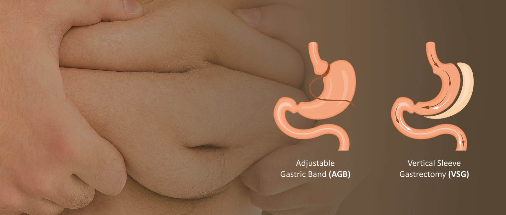 Revision-Bariatric-Surgery